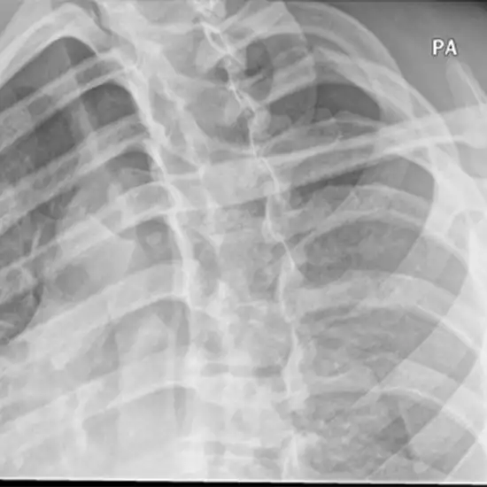 X-ray Sternum Oblique View